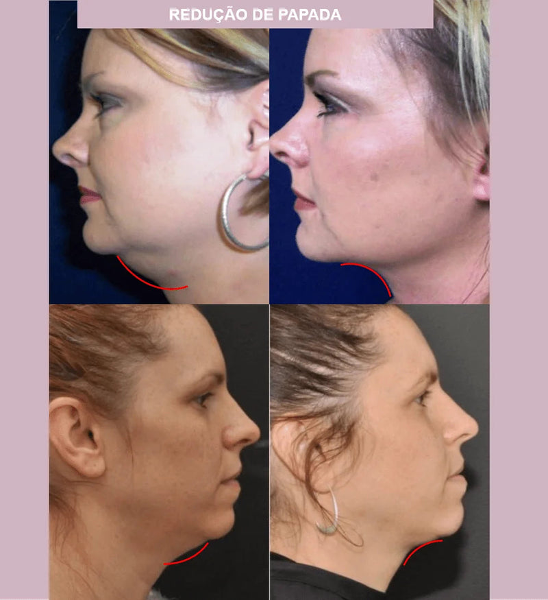 Máscara de Contorno Facial - Suaviza Rugas, Papada e Modela o Rosto